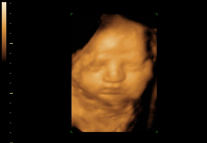 3D ultrasound image at 31 weeks